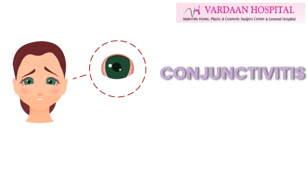 Conjunctivitis