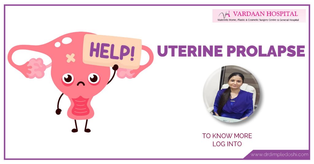 Uterine-Prolapse