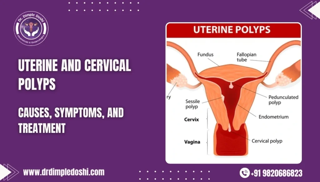 Uterine polyp Image