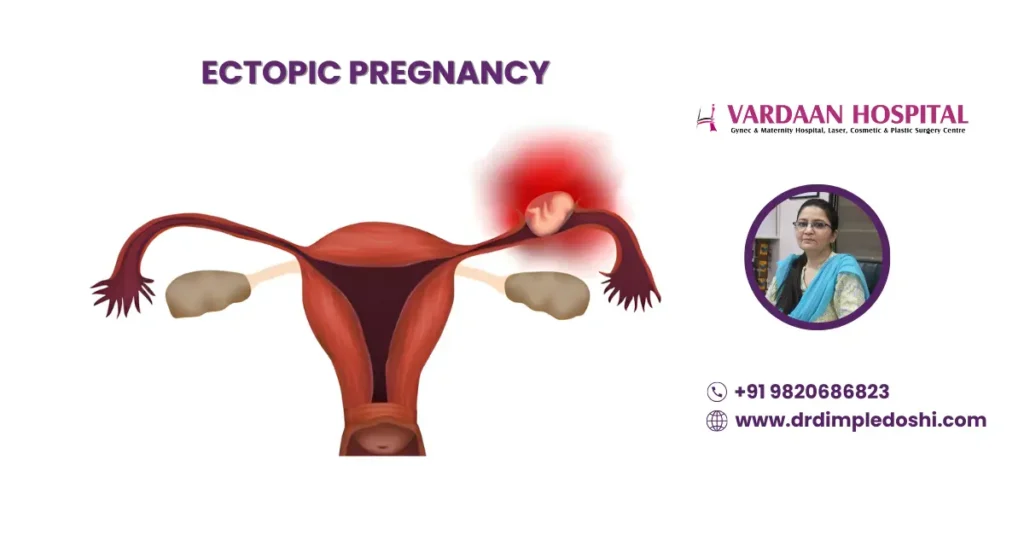 ectopic pregnancy